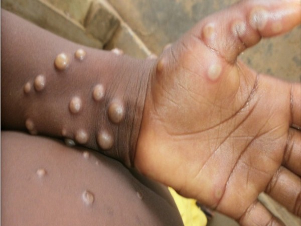 Canada confirms 1,059 monkeypox cases