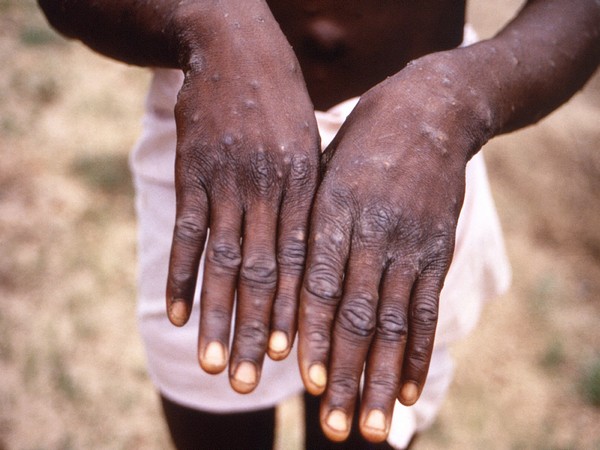 Mexico confirms first imported case of monkeypox