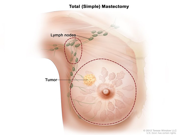New cancer vaccine shows promise, helped kill cancer cells in patient