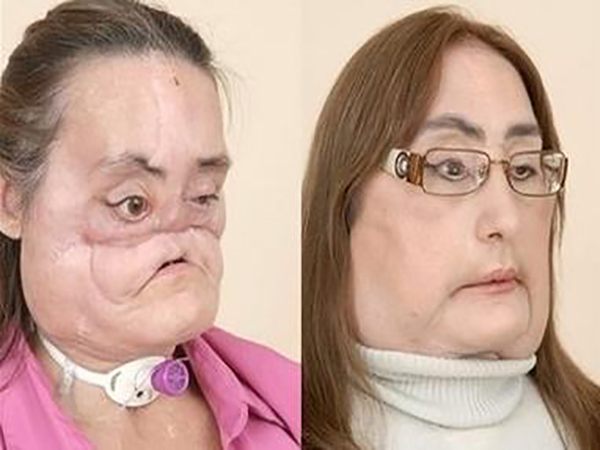Ohio woman who received first US face transplant dead at 57