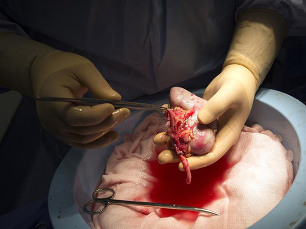Doctors performing kidney transplant on girl, 9, discover shocking abnormality in donated organ