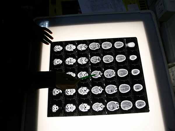 Mind control: Toronto doctors regulate patients' brains from afar using electrode stimulation