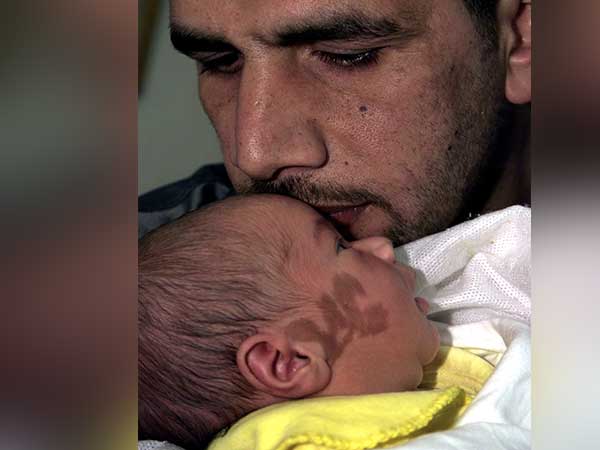 'Now we have the same marks for life': Alberta dad gets matching birthmark in solidarity with son