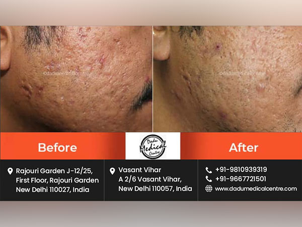 What are the Benefits of Laser Treatment for Acne Scars?