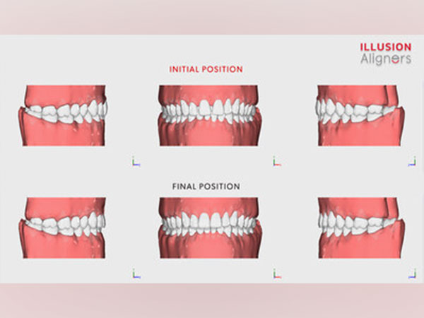 3D Virtual Setup by Illusion Aligners Revealing the Patient's Future Smile with Precision