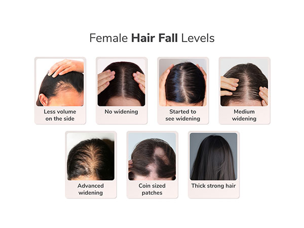 Traya's Study Reveals a Concerning Finding: One in Two Women Aged 36-40 Suffer from Advanced Widening or Female Pattern Hair Loss