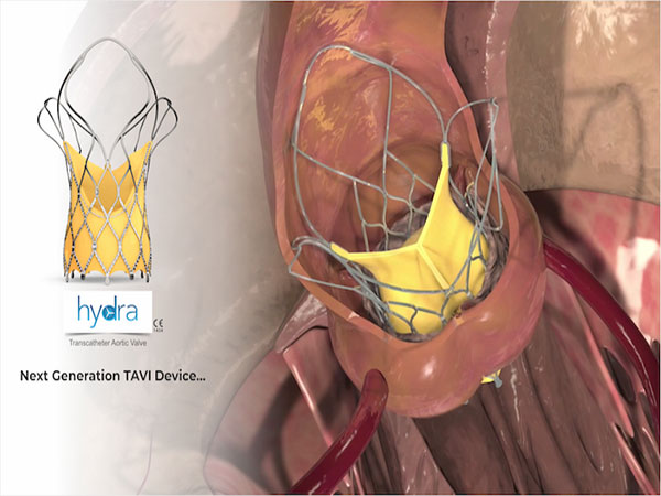 Hydra Aortic Valve