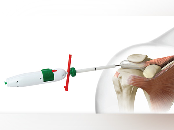 Stryker launches InSpace, first-of-its-kind biodegradable subacromial balloon implant, in India