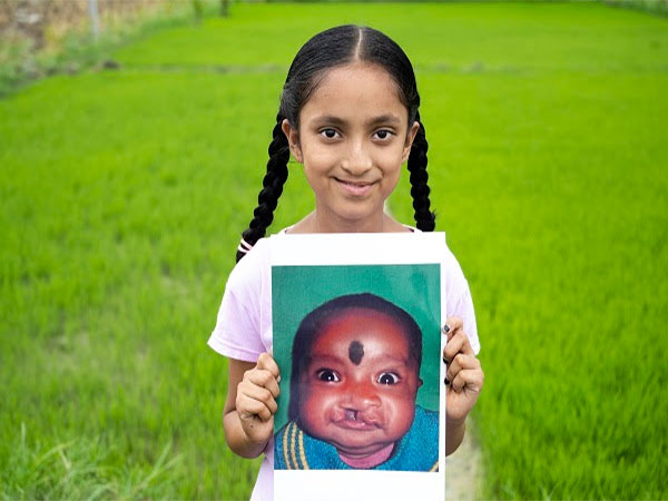 Smile Train and Sirat unite to transform smiles and empower India's cleft community