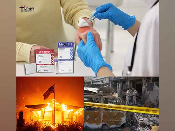 Human BioSciences Addresses the Global Burn Crisis with Advanced Wound Care Solutions