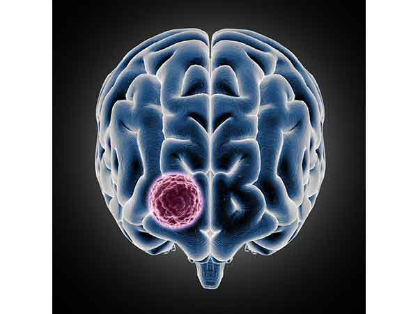 Sakra successfully conducts a landmark surgery for 10*9 cm giant  meningioma on a 34-year-old  international patient from Ghana 