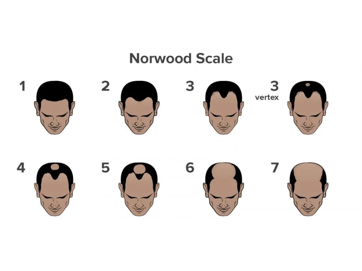 What is Causing Your Hair Fall? Take This Scientifically Backed Hair Loss Quiz