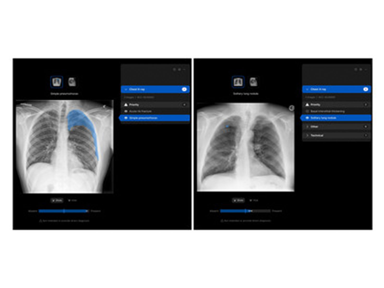 Manipal Hospitals Adopts Harrison.ai's chest X-ray AI to improve patient outcomes
