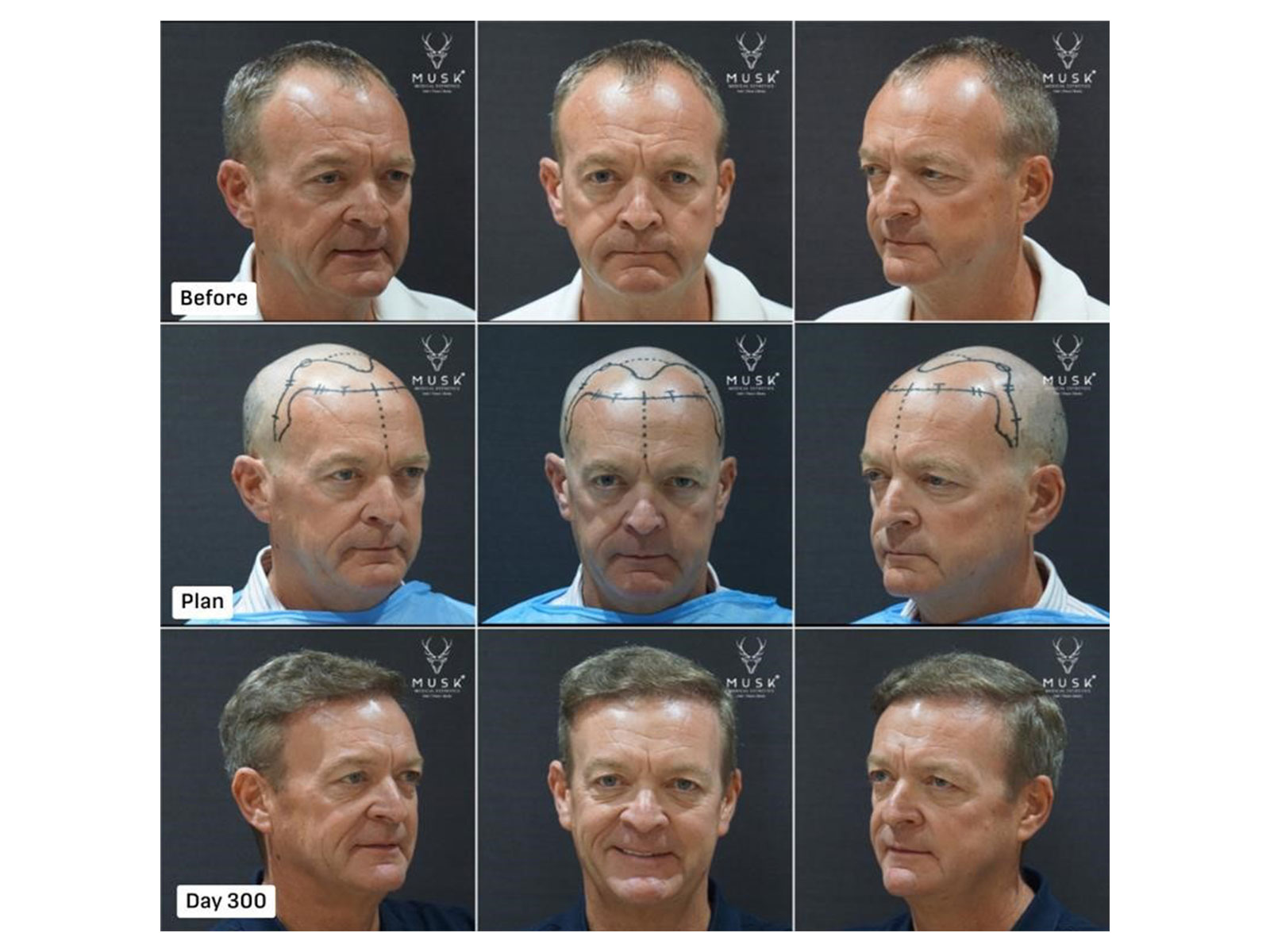 Patient from Ireland, ARTAS Robotic FUE  with 2,611 Hair Grafts (Before-After Hair Transplant Result)