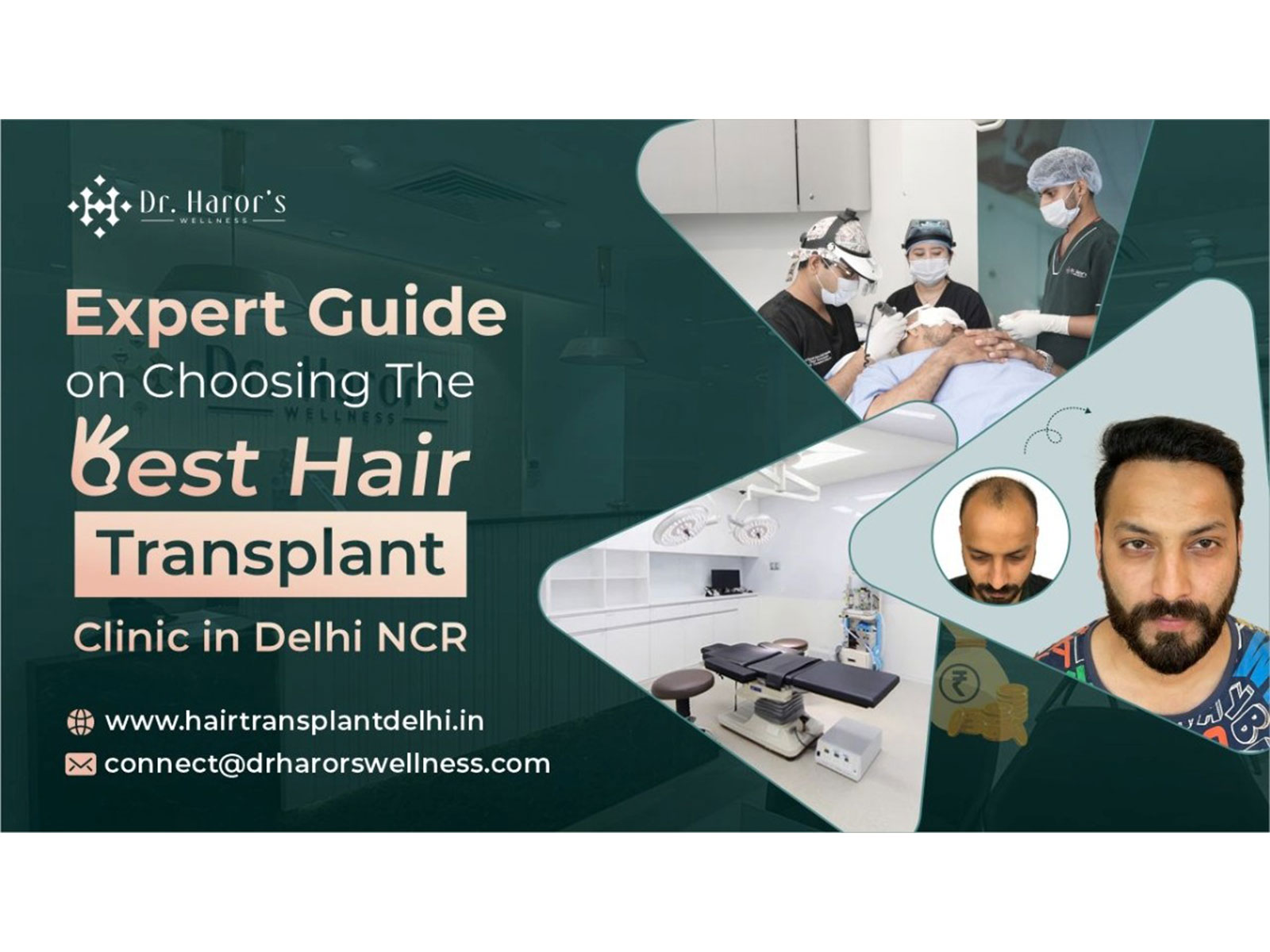 Expert Guide on Choosing the Best Hair Transplant Clinic in Delhi NCR