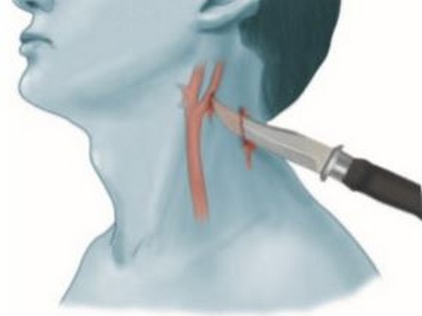 Apollo Doctors' unique adaption technique saves precious life of 15-year-old boy