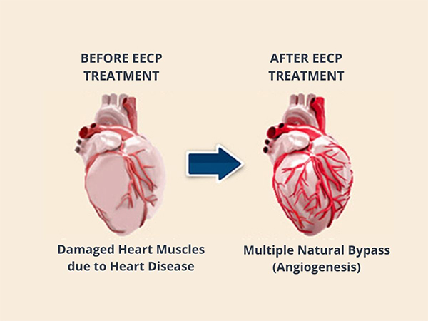 From treating chest pain &improving exercise capacity to reducing chest pain medicine dependency, the US-FDA approved EECP treatment at Cordis Heart Institute and Vedshri Heart Clinics is beneficial.