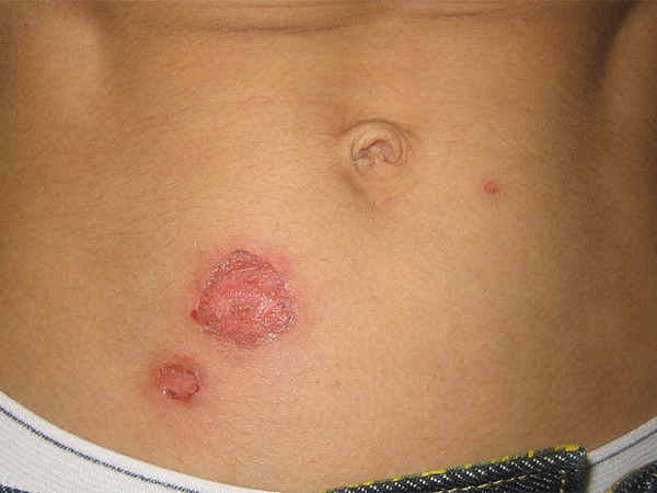 Boy infected with flesh-eating bacteria during trip to Maryland beach, mom says