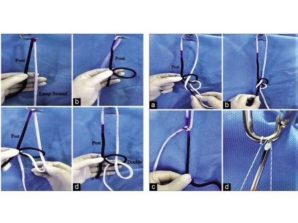 Doctor at Sakra World Hospital invents a new form of Arthroscopy knot - The Banarji's Knot