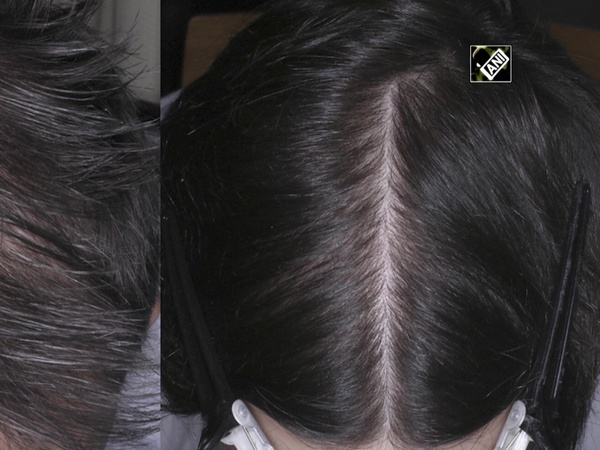 Majority postmenopausal women experience female pattern hair loss: Study