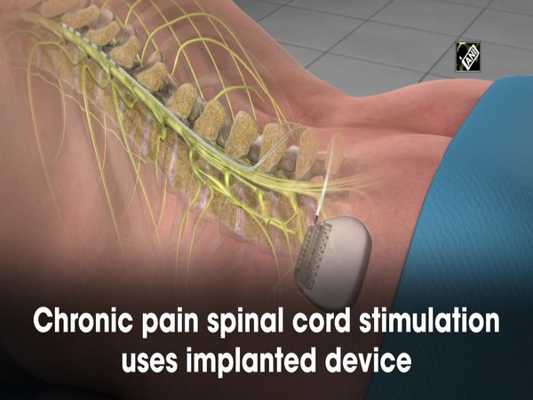 Radiofrequency spinal cord stimulation shows improved longer-lasting pain relief: Study